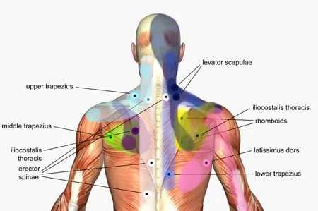 Schéma du dos d'un homme : les muscles sont dessinés et étiquetés (trapèze supérieur, moyen et inférieur, rhomboïdes, grand dorsal, érecteurs du rachis), avec des points de couleur répartis dessus
